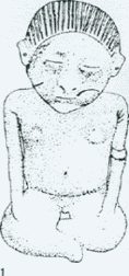 Рис. 1. Фигурка, представляющая сидящего персонажа с признаками худобы как симптома туберкулеза легких (Западная Мексика, штат Наярит, стиль «чинеско»).