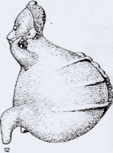 Рис.4. Керамическая фигурка, представляющая исхудавшего персонажа с признаки «водянки» (Западная Мексика, штат Халиско).